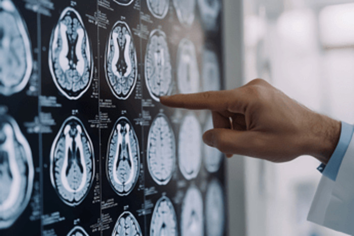 Neurologi: "Per tumori cerebrali la svolta della medicina di precisione"