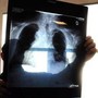 Tumori, in carcinoma polmonare risultati positivi da combinazione in prima linea